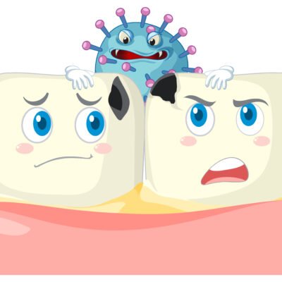 Ilustrácia zubného kazu